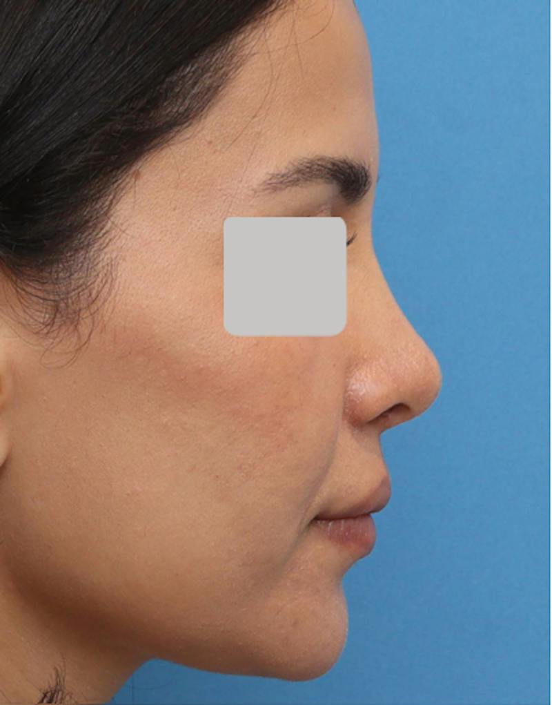 Rhinoplasty  Before & After Gallery - Patient 182736 - Image 4