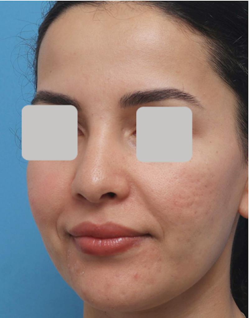 Rhinoplasty  Before & After Gallery - Patient 182736 - Image 7