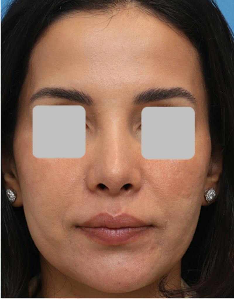 Rhinoplasty  Before & After Gallery - Patient 182736 - Image 2