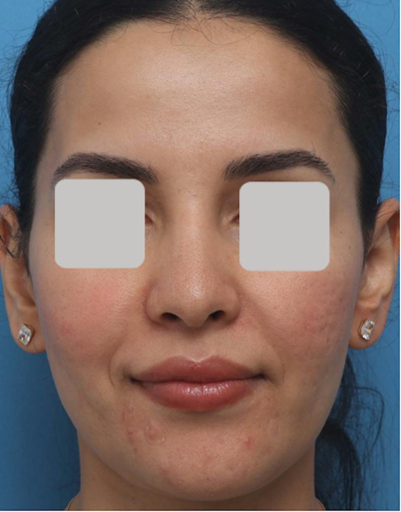 Rhinoplasty  Before & After Gallery - Patient 182736 - Image 1