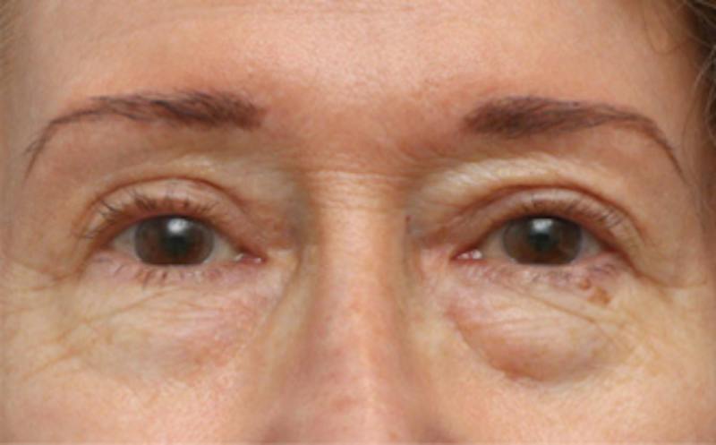 Eyelid Surgery Before & After Gallery - Patient 194398 - Image 2