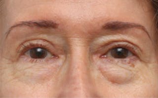 Eyelid Surgery Before & After Gallery - Patient 194398 - Image 2
