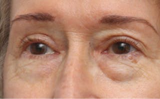 Eyelid Surgery Before & After Gallery - Patient 194398 - Image 4