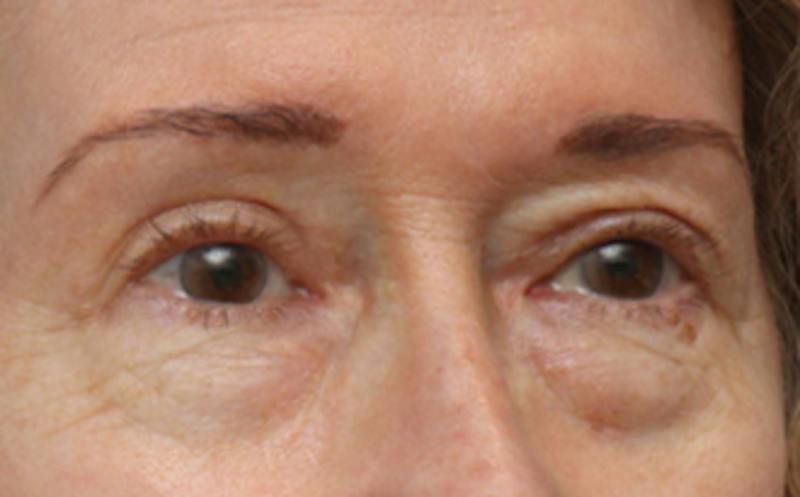 Eyelid Surgery Before & After Gallery - Patient 194398 - Image 6