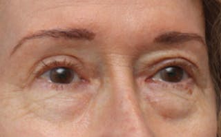 Eyelid Surgery Before & After Gallery - Patient 194398 - Image 6