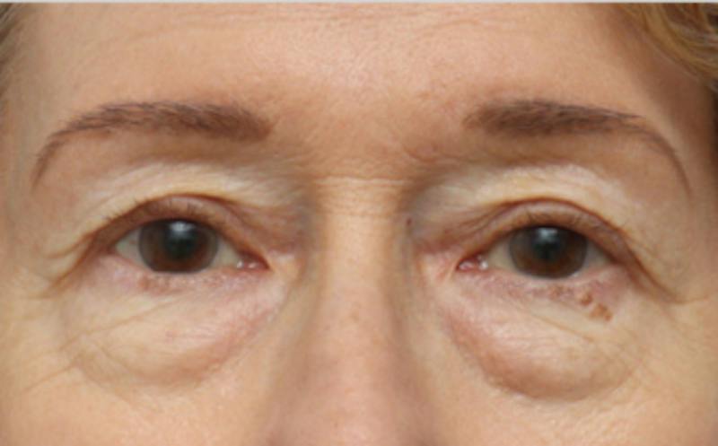 Eyelid Surgery Before & After Gallery - Patient 194398 - Image 1