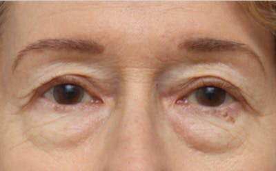 Eyelid Surgery Before & After Gallery - Patient 194398 - Image 1