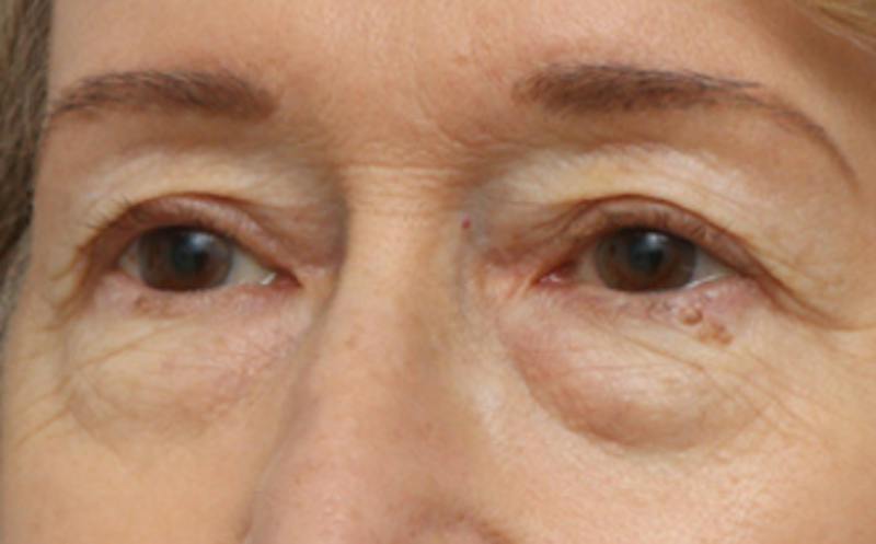 Eyelid Surgery Before & After Gallery - Patient 194398 - Image 3