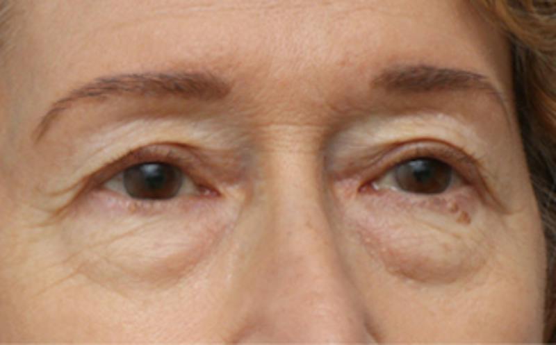 Eyelid Surgery Before & After Gallery - Patient 194398 - Image 5