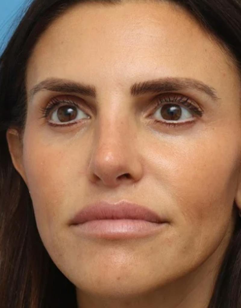 Rhinoplasty Before & After Gallery - Patient 180130 - Image 6
