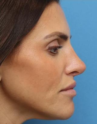 Rhinoplasty Before & After Gallery - Patient 180130 - Image 2