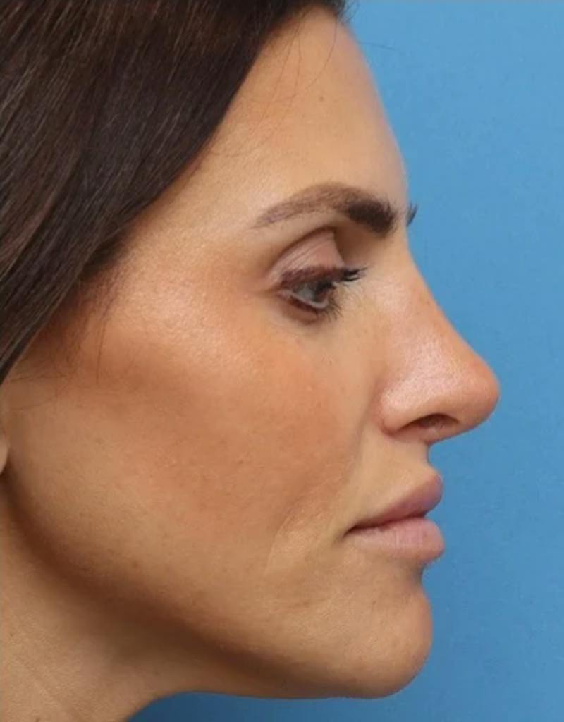 Rhinoplasty Before & After Gallery - Patient 180130 - Image 2