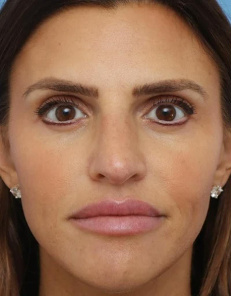 Rhinoplasty Before & After Gallery - Patient 180130 - Image 3