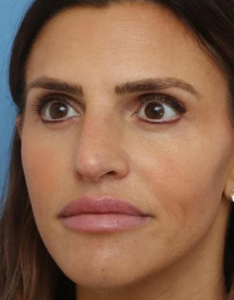 Rhinoplasty Before & After Gallery - Patient 180130 - Image 5