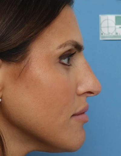 Rhinoplasty Before & After Gallery - Patient 180130 - Image 1