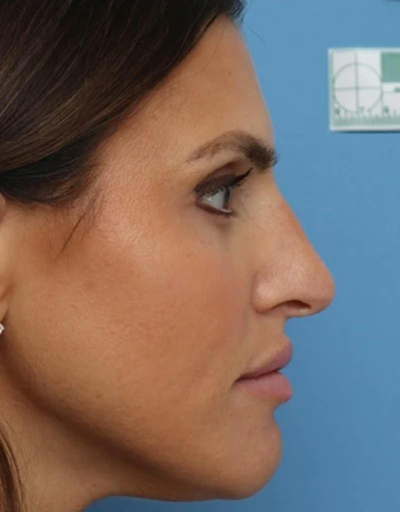 Rhinoplasty Before & After Gallery - Patient 180130 - Image 1