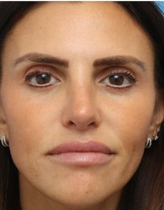 Rhinoplasty Before & After Gallery - Patient 180130 - Image 4