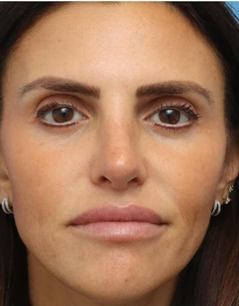Rhinoplasty Before & After Gallery - Patient 180130 - Image 4