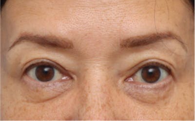 Eyelid Surgery Before & After Gallery - Patient 269896 - Image 1