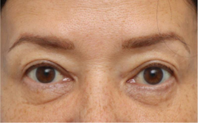 Eyelid Surgery Before & After Gallery - Patient 269896 - Image 1