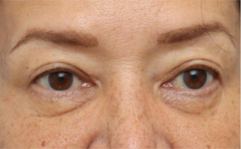 Eyelid Surgery Before & After Gallery - Patient 269896 - Image 6