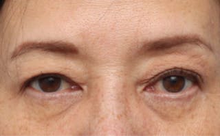 Eyelid Surgery Before & After Gallery - Patient 269896 - Image 2