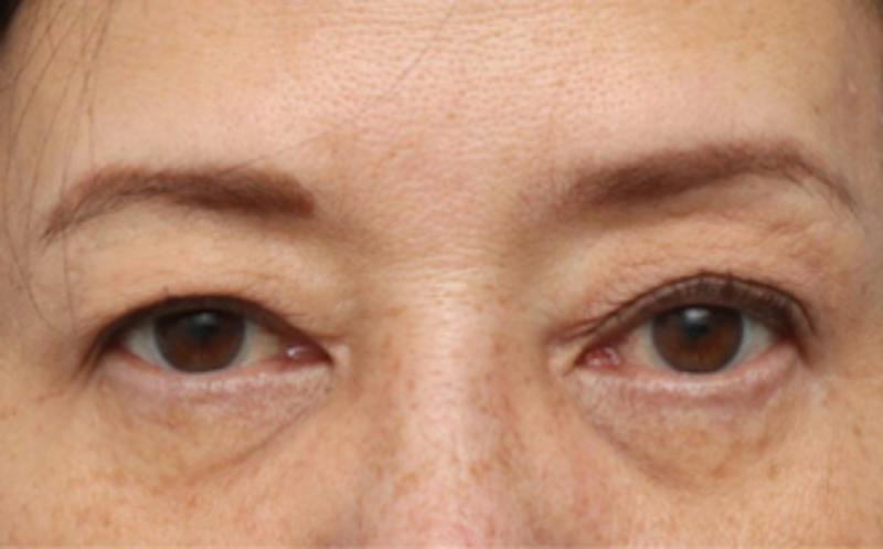 Eyelid Surgery Before & After Gallery - Patient 269896 - Image 2