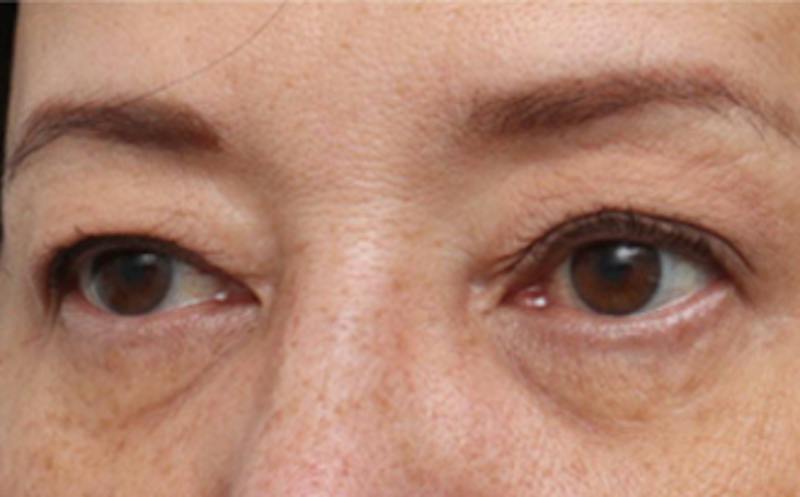 Eyelid Surgery Before & After Gallery - Patient 269896 - Image 3