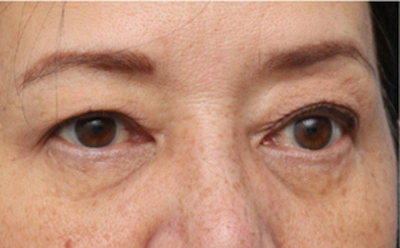 Eyelid Surgery Before & After Gallery - Patient 269896 - Image 5