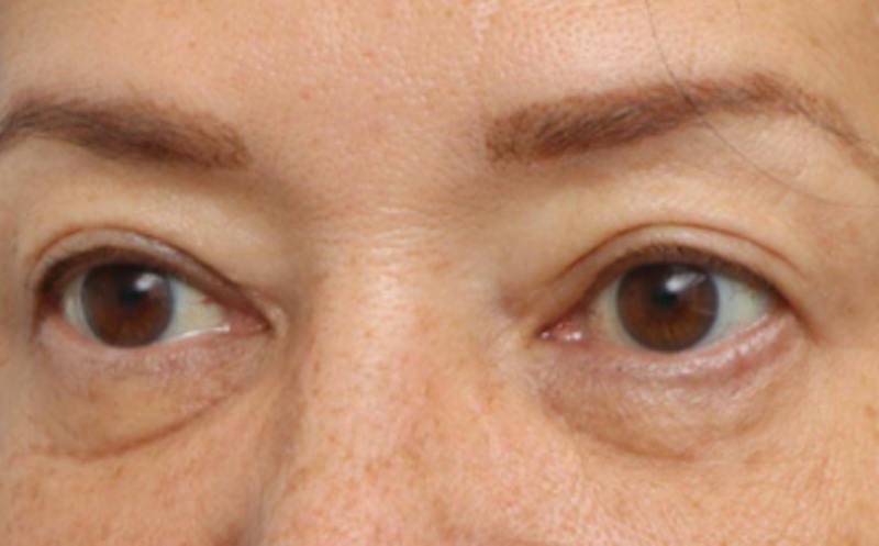 Eyelid Surgery Before & After Gallery - Patient 269896 - Image 4