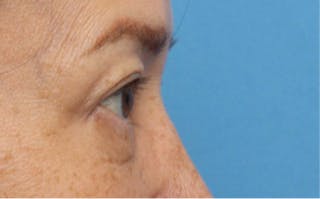 Eyelid Surgery Before & After Gallery - Patient 269896 - Image 8