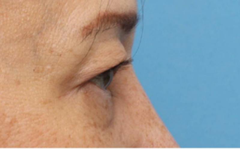 Eyelid Surgery Before & After Gallery - Patient 269896 - Image 7