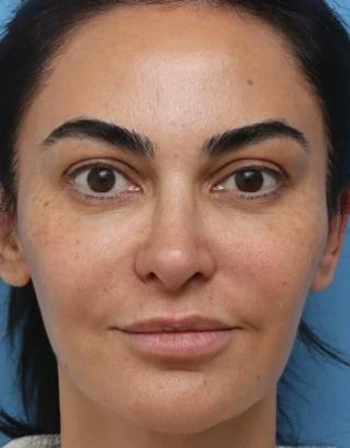 Rhinoplasty Before & After Gallery - Patient 212071 - Image 4