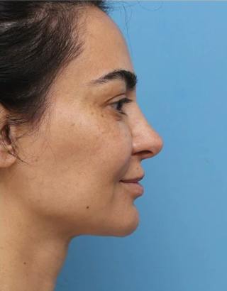 Rhinoplasty Before & After Gallery - Patient 212071 - Image 2