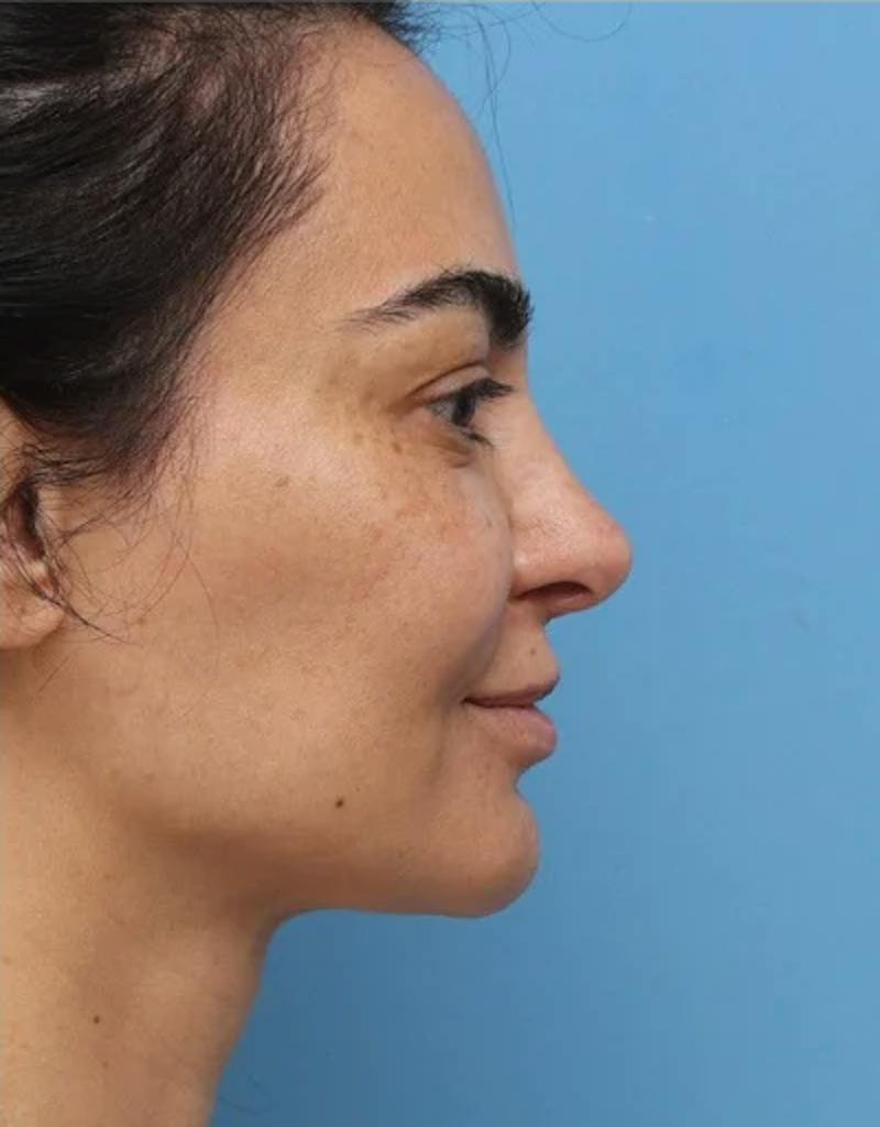 Rhinoplasty Before & After Gallery - Patient 212071 - Image 2