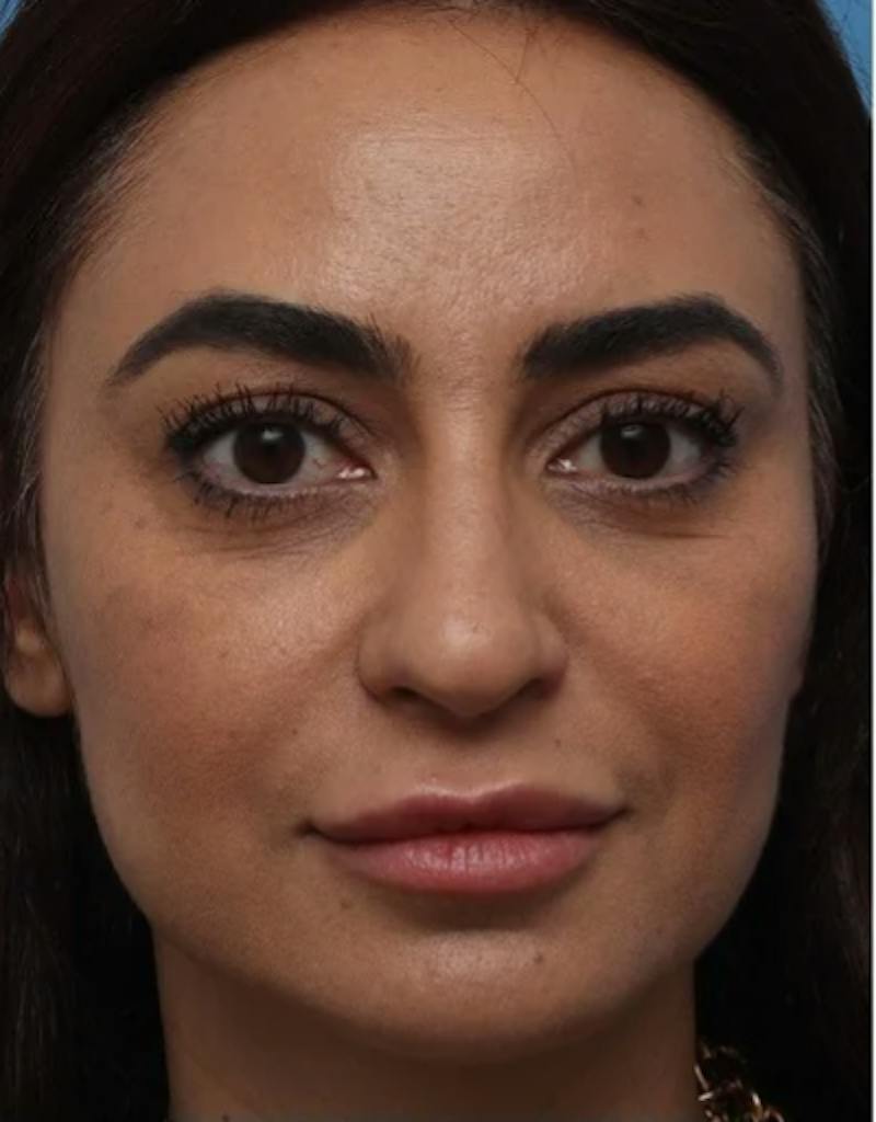 Rhinoplasty Before & After Gallery - Patient 212071 - Image 3