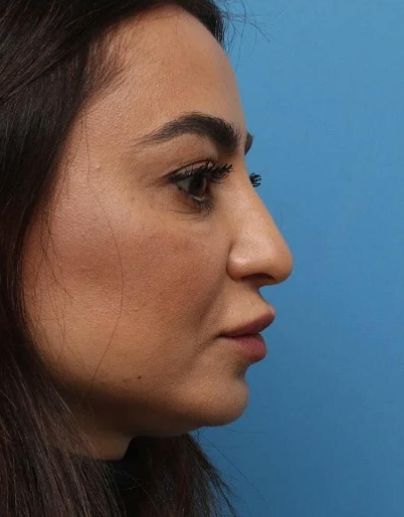 Rhinoplasty Before & After Gallery - Patient 212071 - Image 1