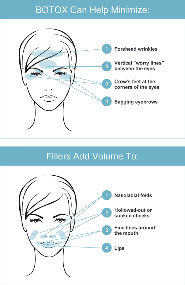 Botox diagram