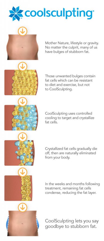 Coolsculpting diagram