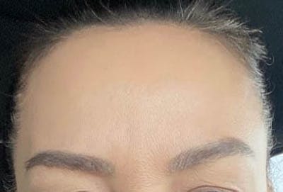 After - Woman's Forehead