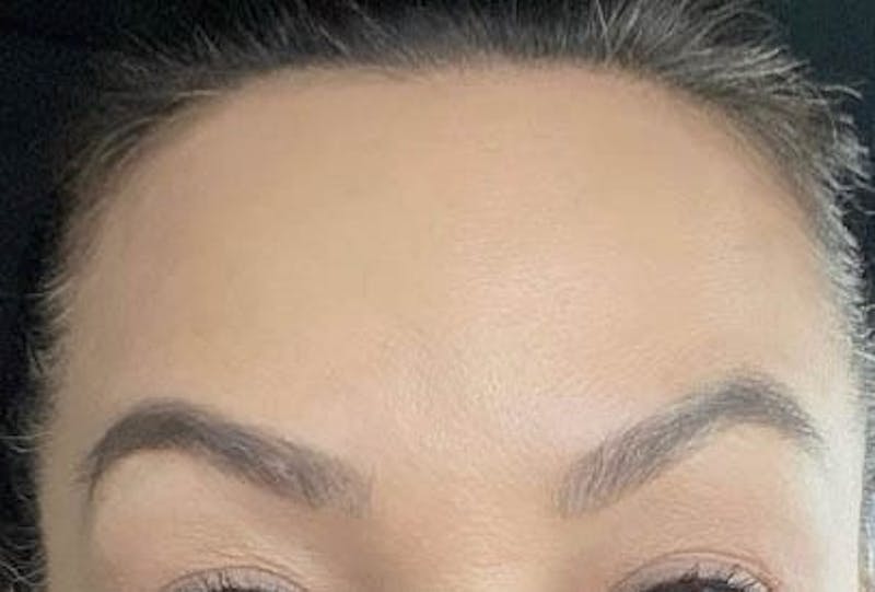 After - Woman's Forehead