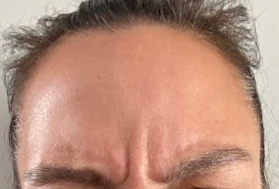 Before - Woman's Forehead