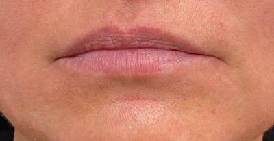 Restylane Before & After Gallery - Patient 275678 - Image 1
