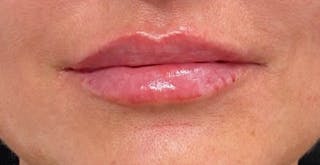 After - Woman's Lips