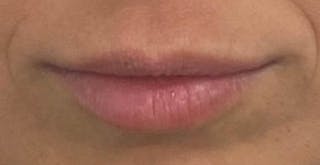 Before - Woman's Lips