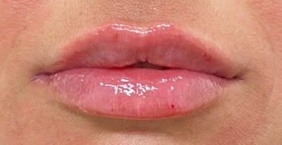 After - Woman's lips