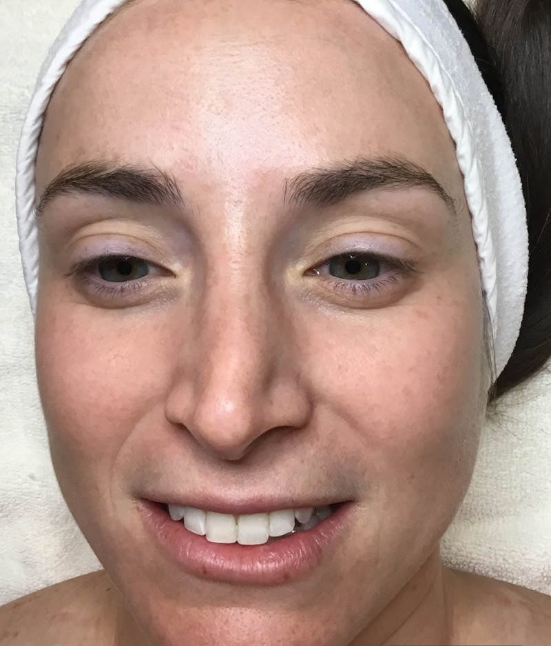 Photofacial Before & After Gallery - Patient 330039 - Image 8