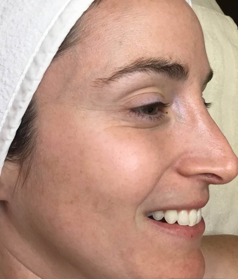 Photofacial Before & After Gallery - Patient 330039 - Image 12