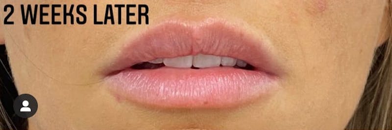 Filler Before & After Gallery - Patient 232306 - Image 3