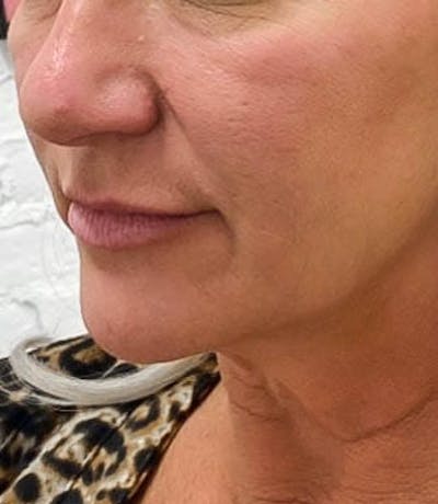 Filler Before & After Gallery - Patient 145116 - Image 2